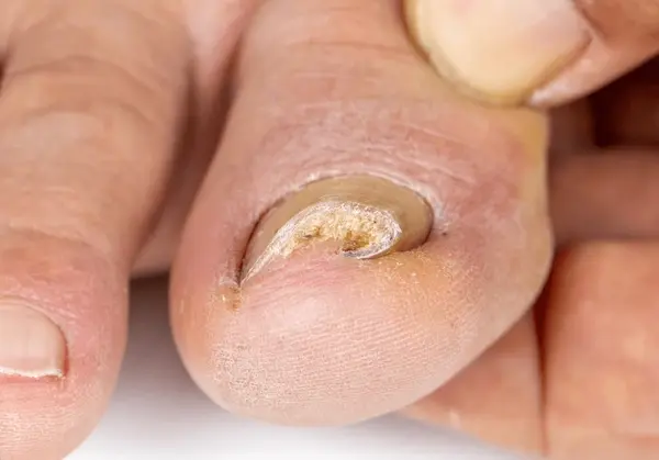 ingrown toenail treatment in harrison and mountain home, ar