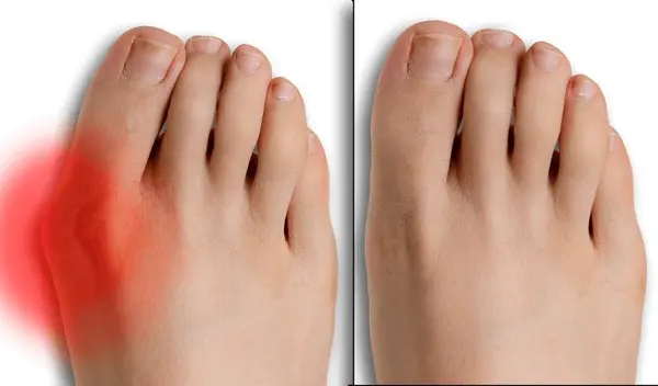 mis bunion surgery near you