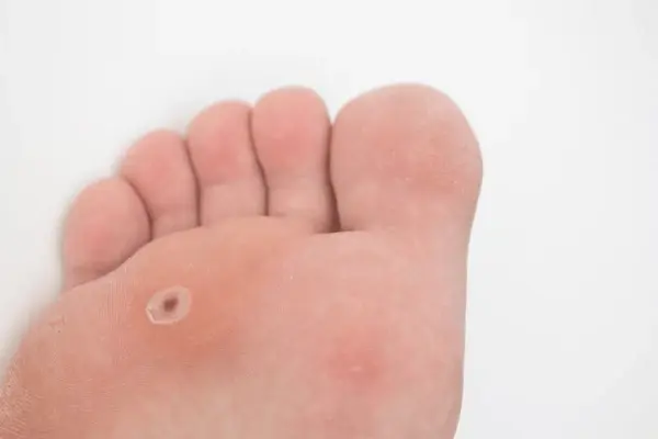 plantar wart treatment in harrison and mountain home, ar
